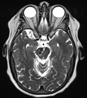 Case Report: Sequential Transarterial and Trans-Cortical Venous Embolization of a Mixed Pial-Dural AVM